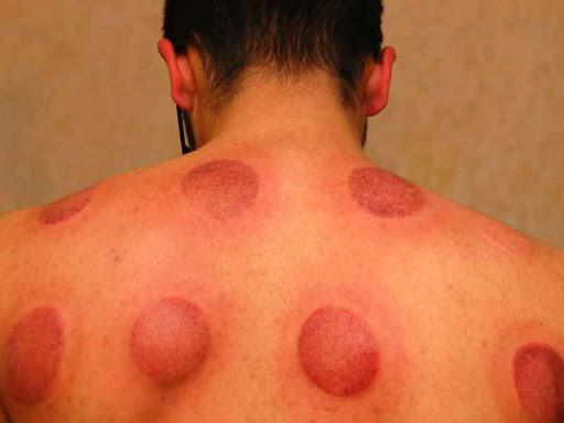 Things to know about hijama therapy